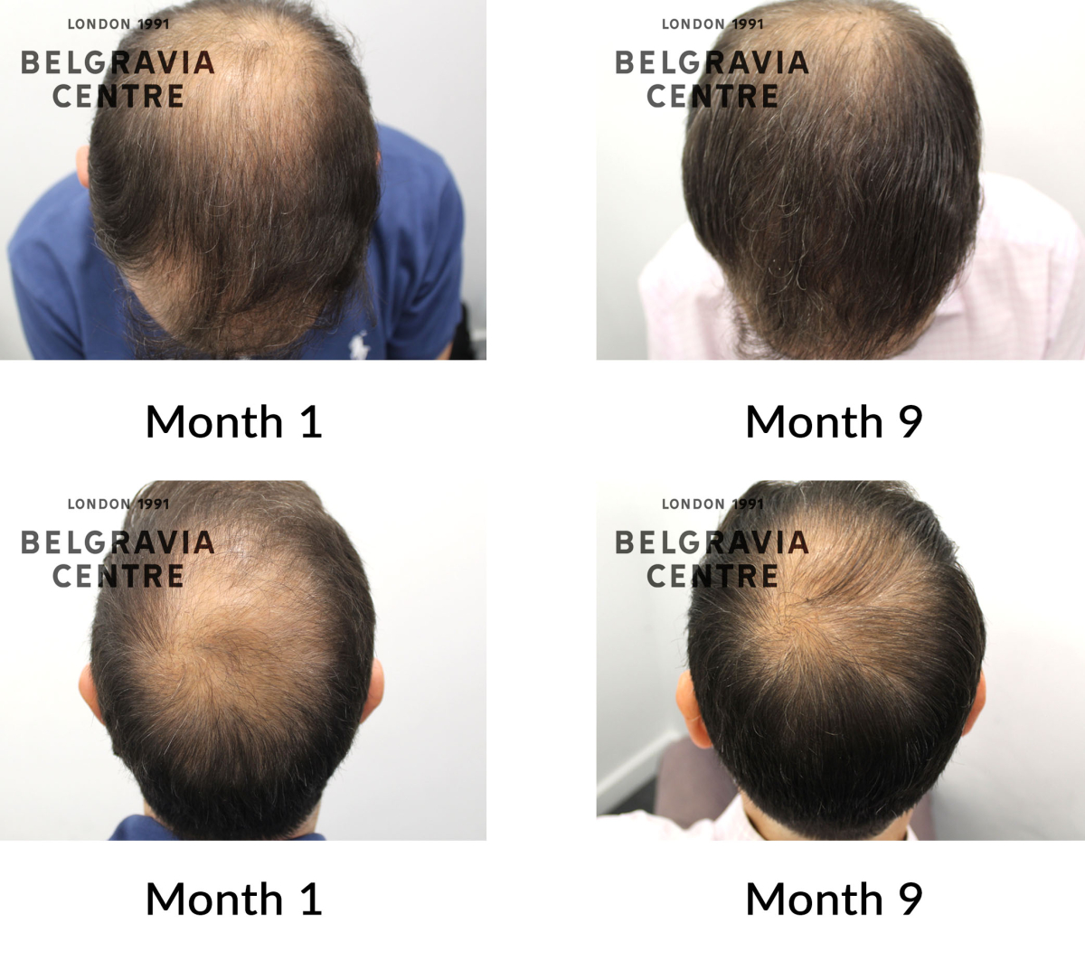 male pattern hair loss the belgravia centre 225236