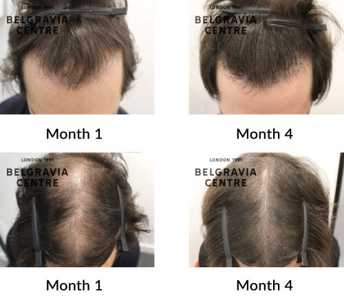 male pattern hair loss the belgravia centre 443850