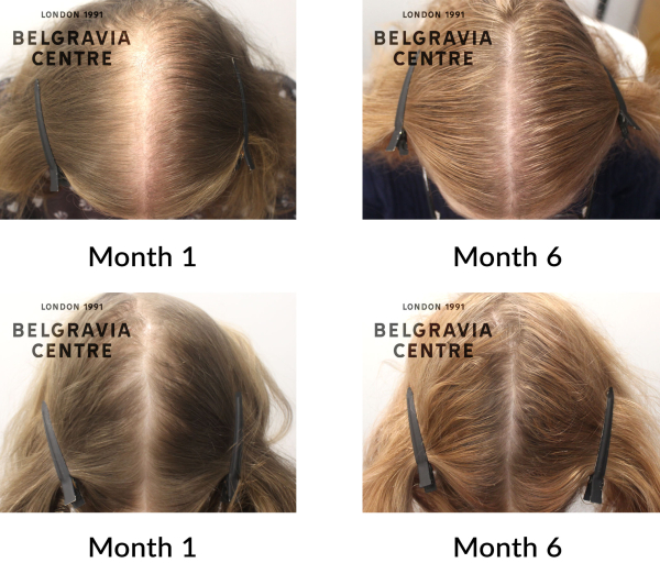 female pattern hair loss the belgravia centre 444338
