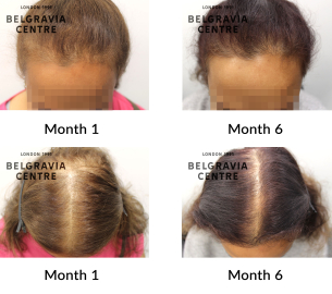 female pattern hair loss and diffuse thinning the belgravia centre 441695 copy