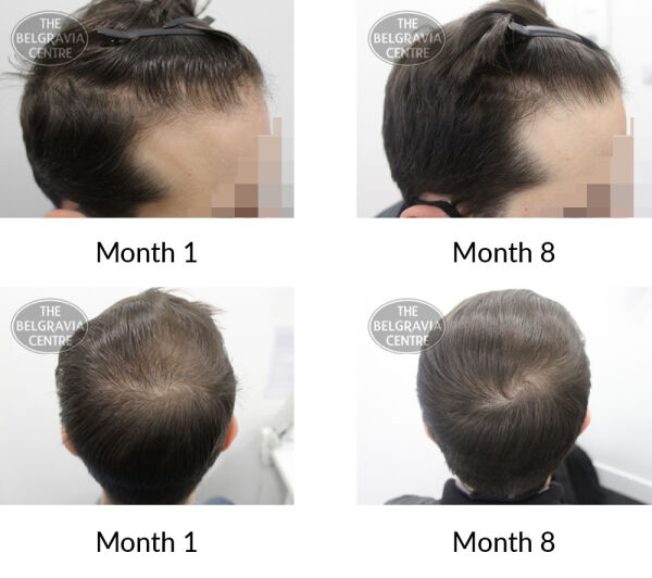 male pattern hair loss the belgravia centre 409679 13 05 2021