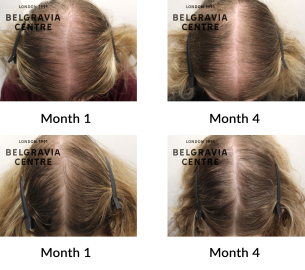 diffuse thinning and female pattern hair loss the belgravia centre 443179