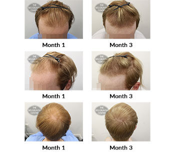 alert male pattern hair loss the belgravia centre 425331 22 09 2021