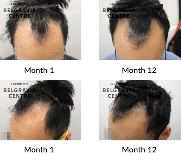 male pattern hair loss the belgravia centre 433275
