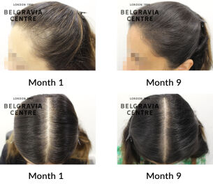 female pattern hair loss the belgravia centre 427240