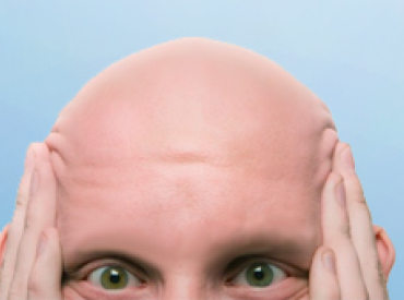 The Effects of Alopecia Areata Hair Loss