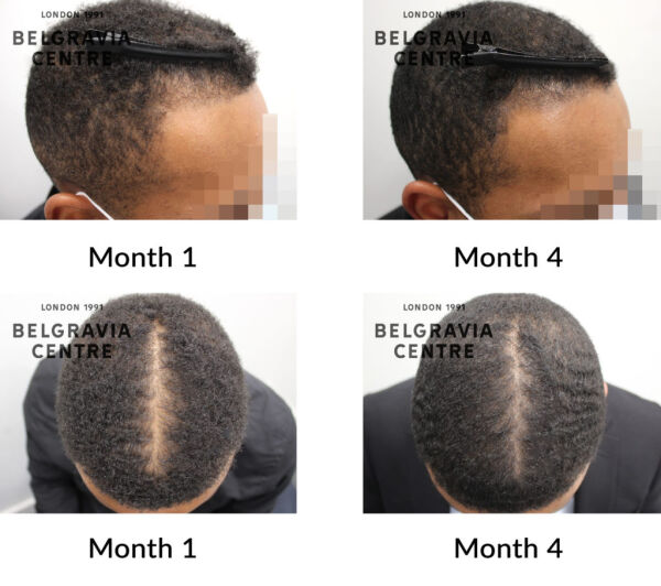 6 reasons why men in their 20s loosing hair heres how you can treat your  baldness