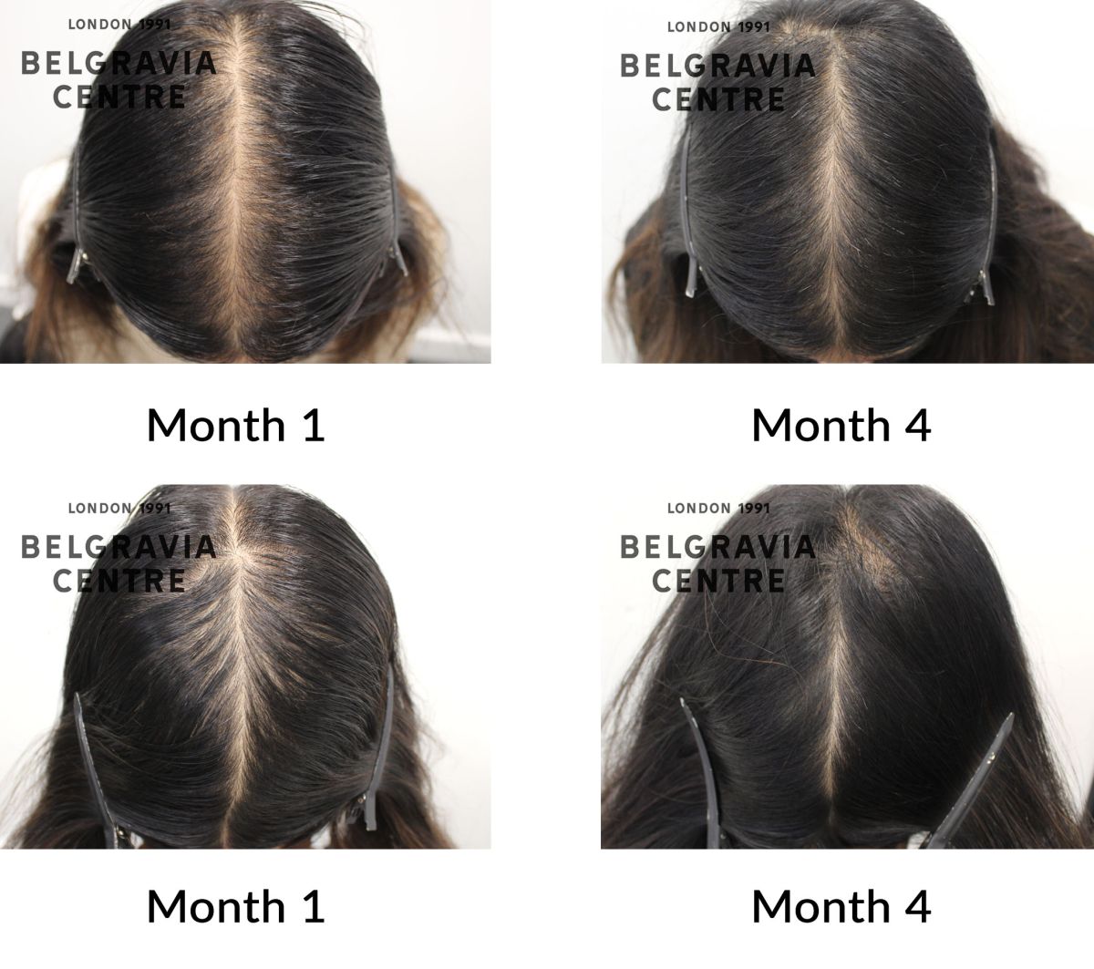 female pattern hair loss and telogen effluvium the belgravia centre 450814