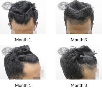 alert male pattern hair loss the belgravia centre 407278 02 02 2021