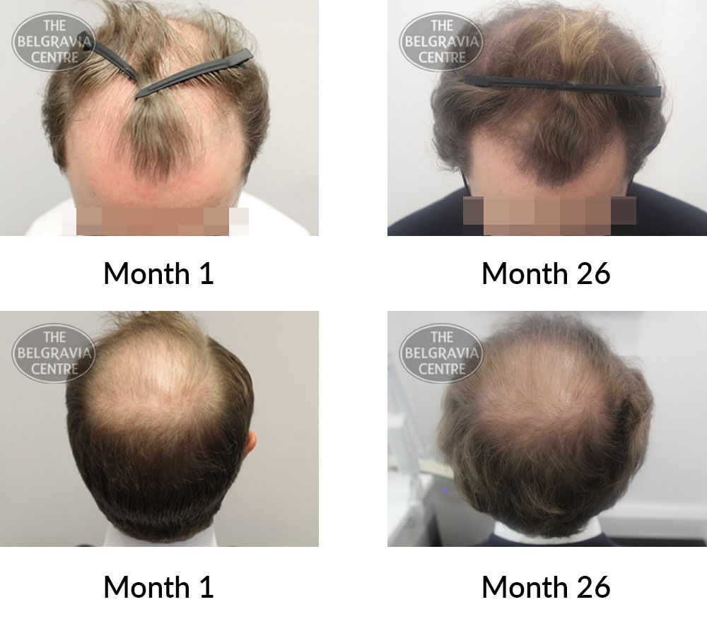 male pattern hair loss the belgravia centre 381838 25 06 2021