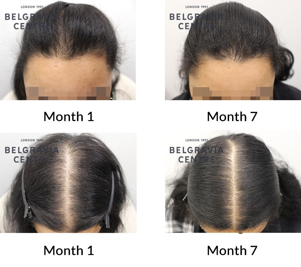 female pattern hair loss and diffuse thinning the belgravia centre 422038 230821