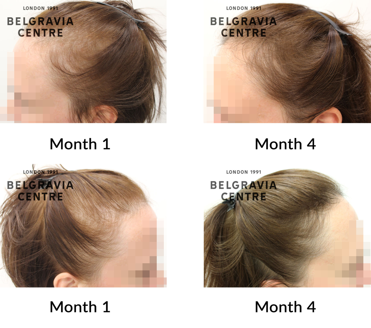 female pattern hair loss the belgravia centre 446356