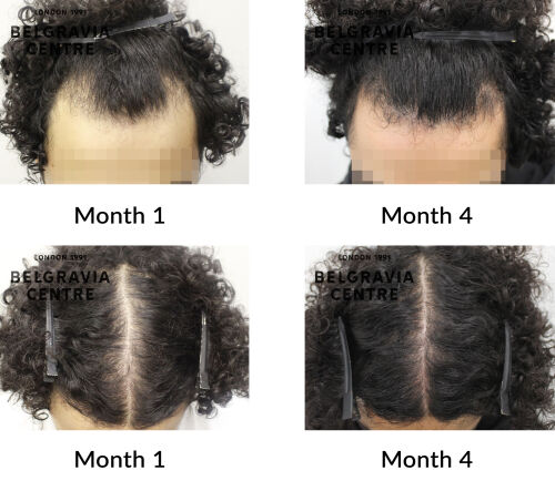 male pattern hair loss the belgravia centre 444671