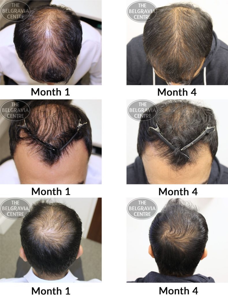 male pattern hair loss the belgravia centre al 22 05 2017 790x1024