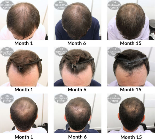male pattern hair loss the belgravia centre sm 20 02 2017