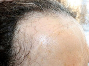 Frontal Fibrosing Alopecia A Form of Scarring Alopecia