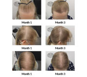 alert female pattern hair loss and diffuse thinning the belgravia centre 407978 16 12 2020