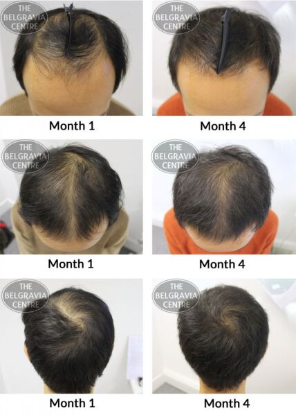 Male Pattern Hair Loss The Belgravia Centre AT 15 05 729x1024