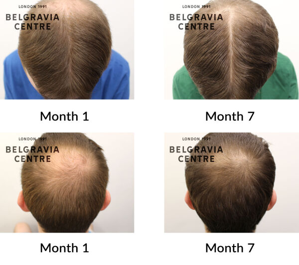 male pattern hair loss the belgravia centre 443094