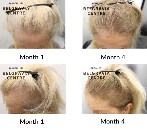female pattern hair loss the belgravia centre 461369