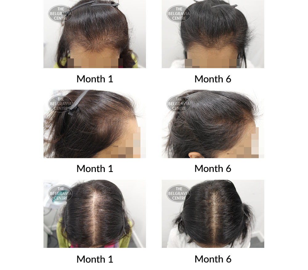 female pattern hair loss the belgravia centre 26975 23 07 2020