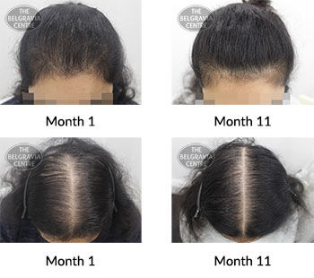 alert female pattern hair loss the belgravia centre 112183 07 09 2021