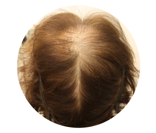 Thinning hair on top clearance of head female