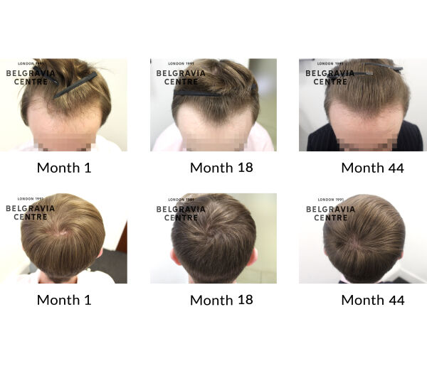 male pattern hair loss the belgravia centre 367983