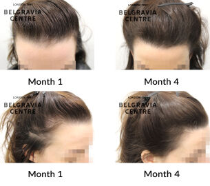 female pattern hair loss and diffuse thinning the belgravia centre 451569