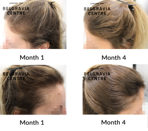 female pattern hair loss and diffuse thinning the belgravia centre 454353