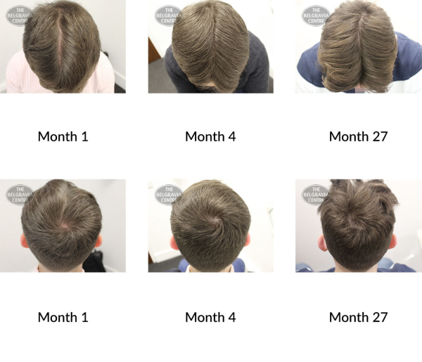 male pattern hair loss the belgravia centre 369941 11 01 2021