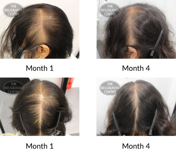 female pattern hair loss and diffuse thinning the belgravia centre 426438 111121