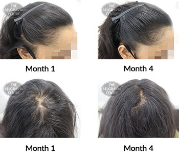 alert trichotillomania and female pattern hair loss the belgravia centre 360764 30 07 2021