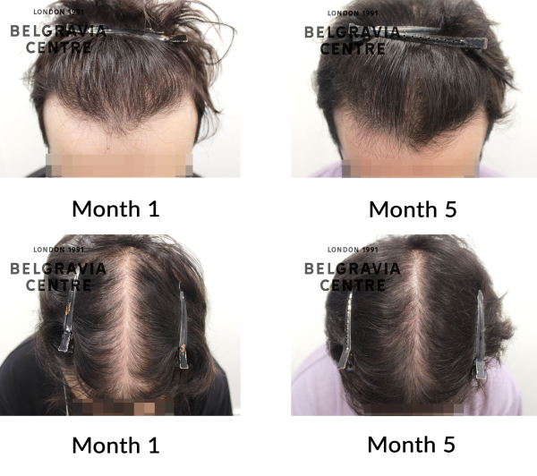 male pattern hair loss the belgravia centre 458545
