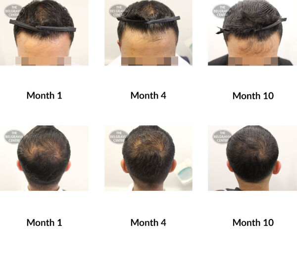 male pattern hair loss the belgravia centre 382600 13 03 2020