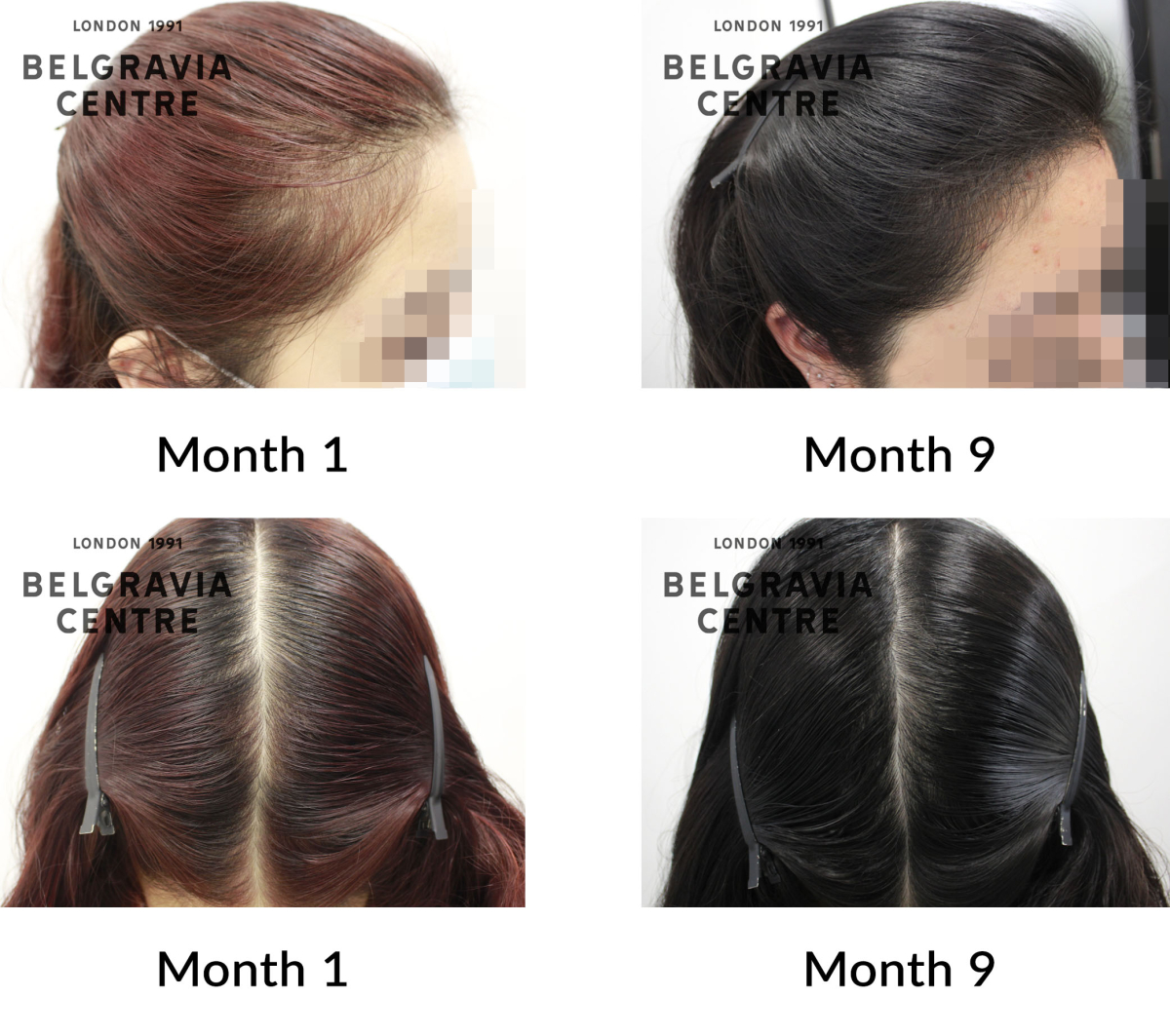 telogen effluvium and female pattern hair loss the belgravia centre 428629