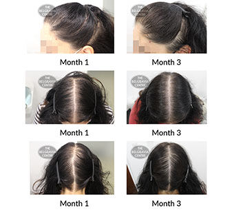 alert female pattern hair loss and diffuse thinning the belgravia centre 423622 23 08 2021