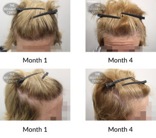 female pattern hair loss the belgravia centre 423158 03 09 2021