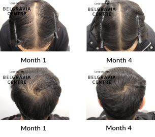 male pattern pattern hair loss the belgravia centre 467146