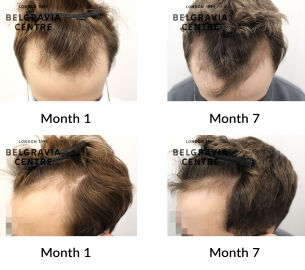male pattern hair loss the belgravia centre 432401