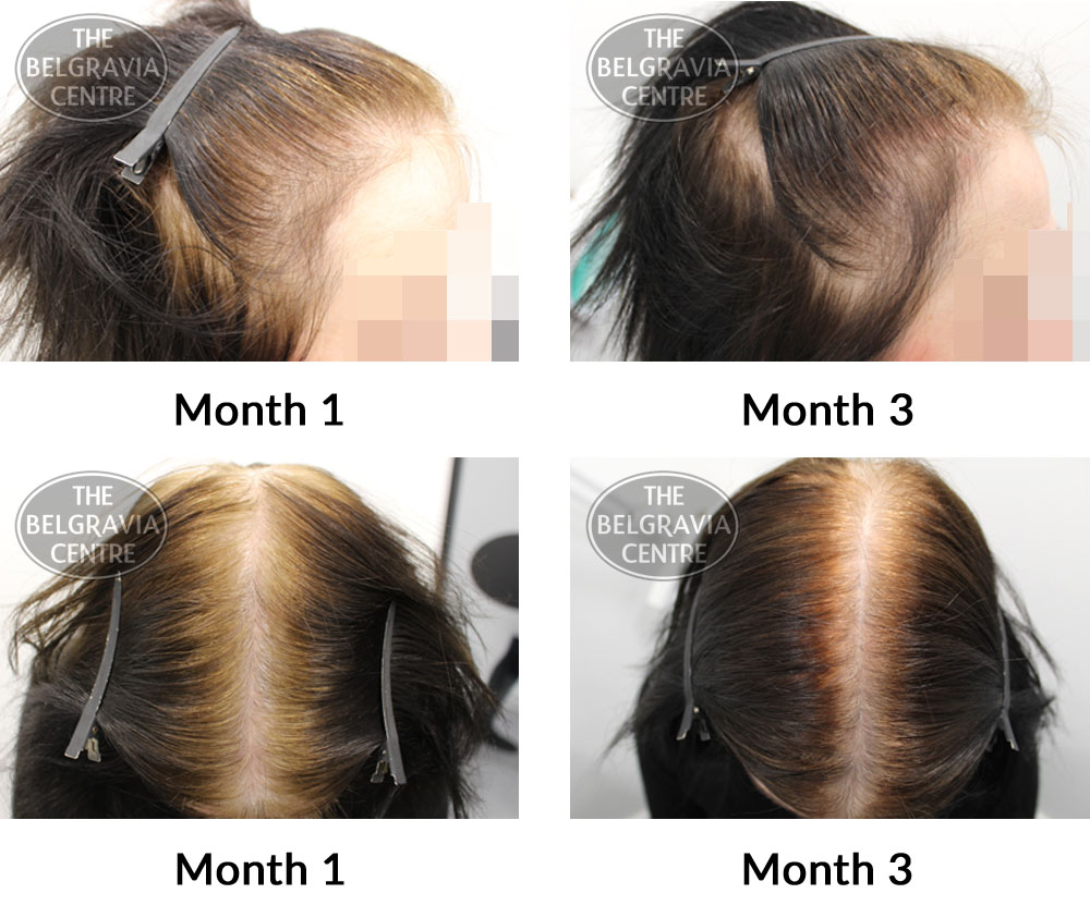female pattern hair loss the belgravia centre 375672 08 04 2019