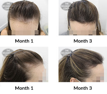 alert female pattern hair loss the belgravia centre 426380 05 11 2021
