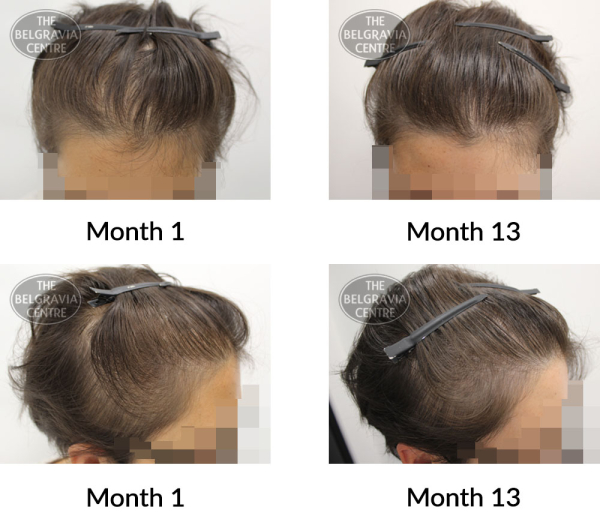 female pattern hair loss the belgravia centre 404331 23 07 2021