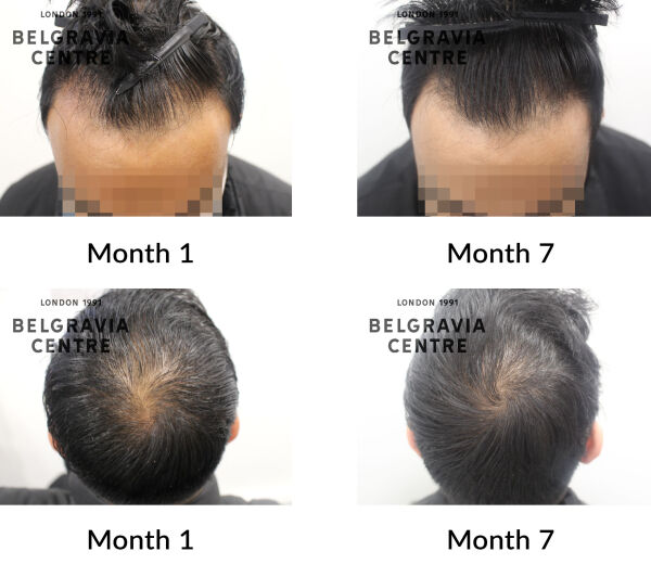 male pattern hair loss the belgravia centre 429439