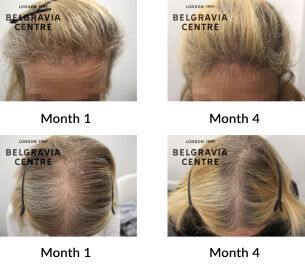 female pattern hair loss the belgravia centre 442123