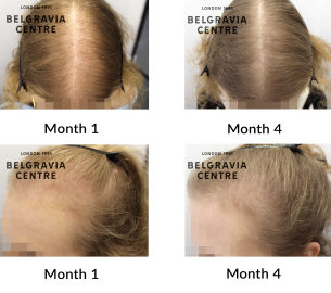 female pattern hair loss and diffuse thinning 467800