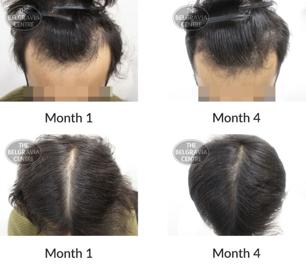 male pattern hair loss the belgravia centre 404133 19 10 2020