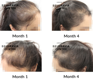 female pattern hair loss the belgravia centre 467294