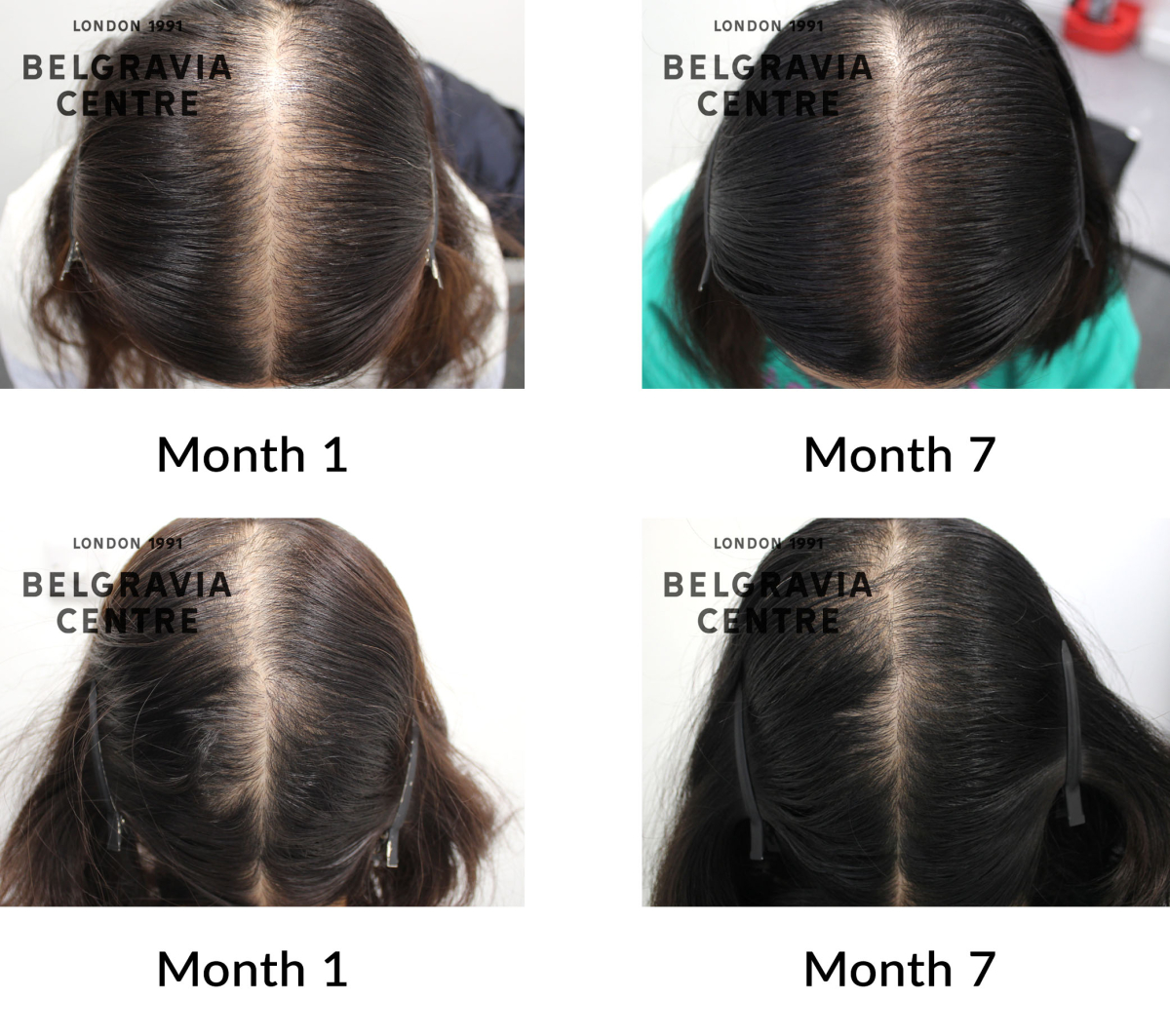 female pattern hair loss the belgravia centre 433436