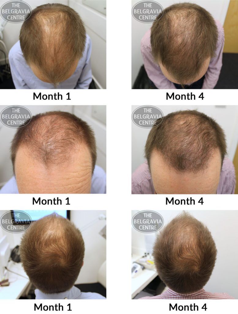 male pattern hair loss the belgravia centre mm 14 12 777x1024